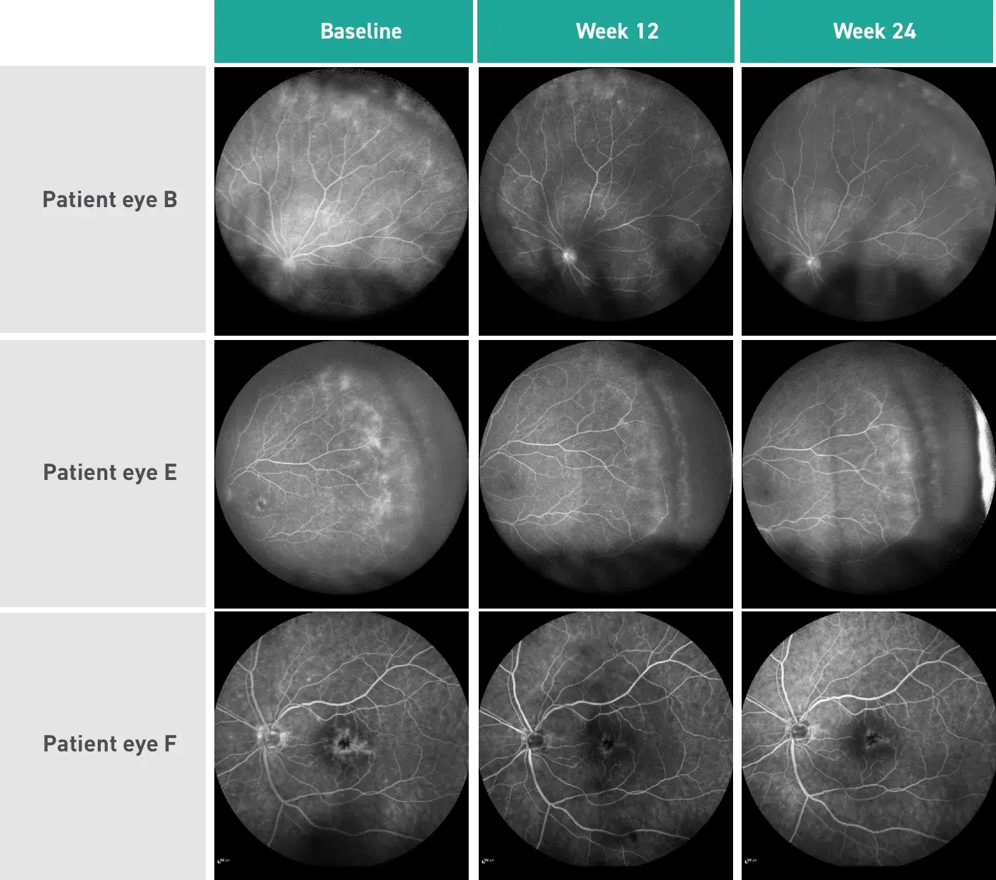 Acthar Gel retinal vasculitis results: improvement seen by Week 24
